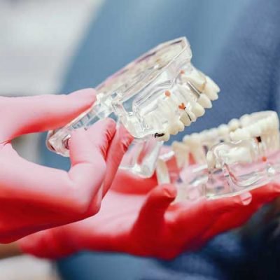 Choosing-the-Best-Invisalign-Provider-Factors-to-Consider