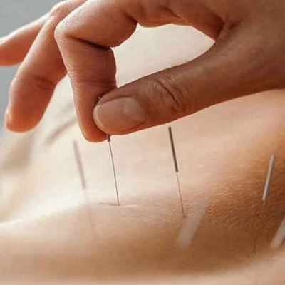 What-is-Acupuncture