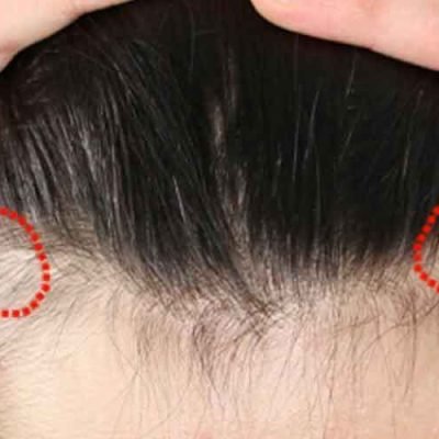 Traction-Alopecia