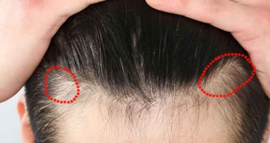 Traction-Alopecia