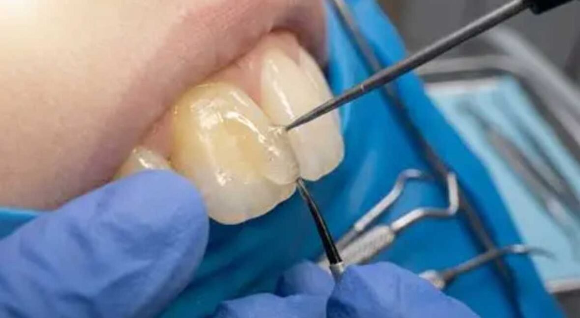 How Dentists in Rolla Treat Exposed Root Surfaces with Dental Bonding