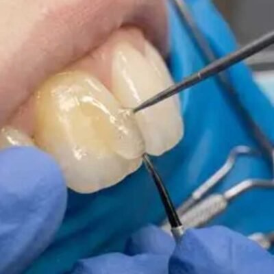 How Dentists in Rolla Treat Exposed Root Surfaces with Dental Bonding