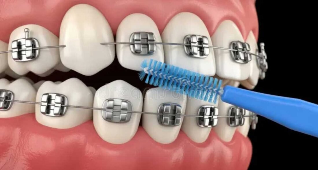 How to Clean Around Brackets and Wires in Under Three Minutes in Brookhaven