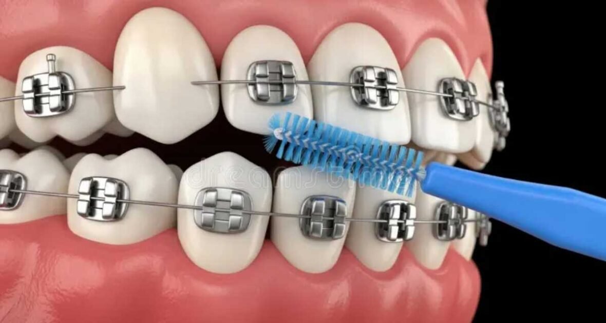 How to Clean Around Brackets and Wires in Under Three Minutes in Brookhaven