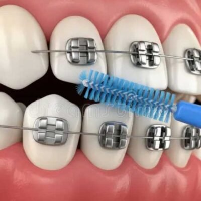 How to Clean Around Brackets and Wires in Under Three Minutes in Brookhaven
