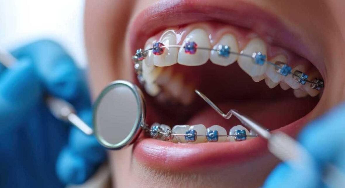 Types of Braces and Their Features Explained for First-Time Patients in Kelowna